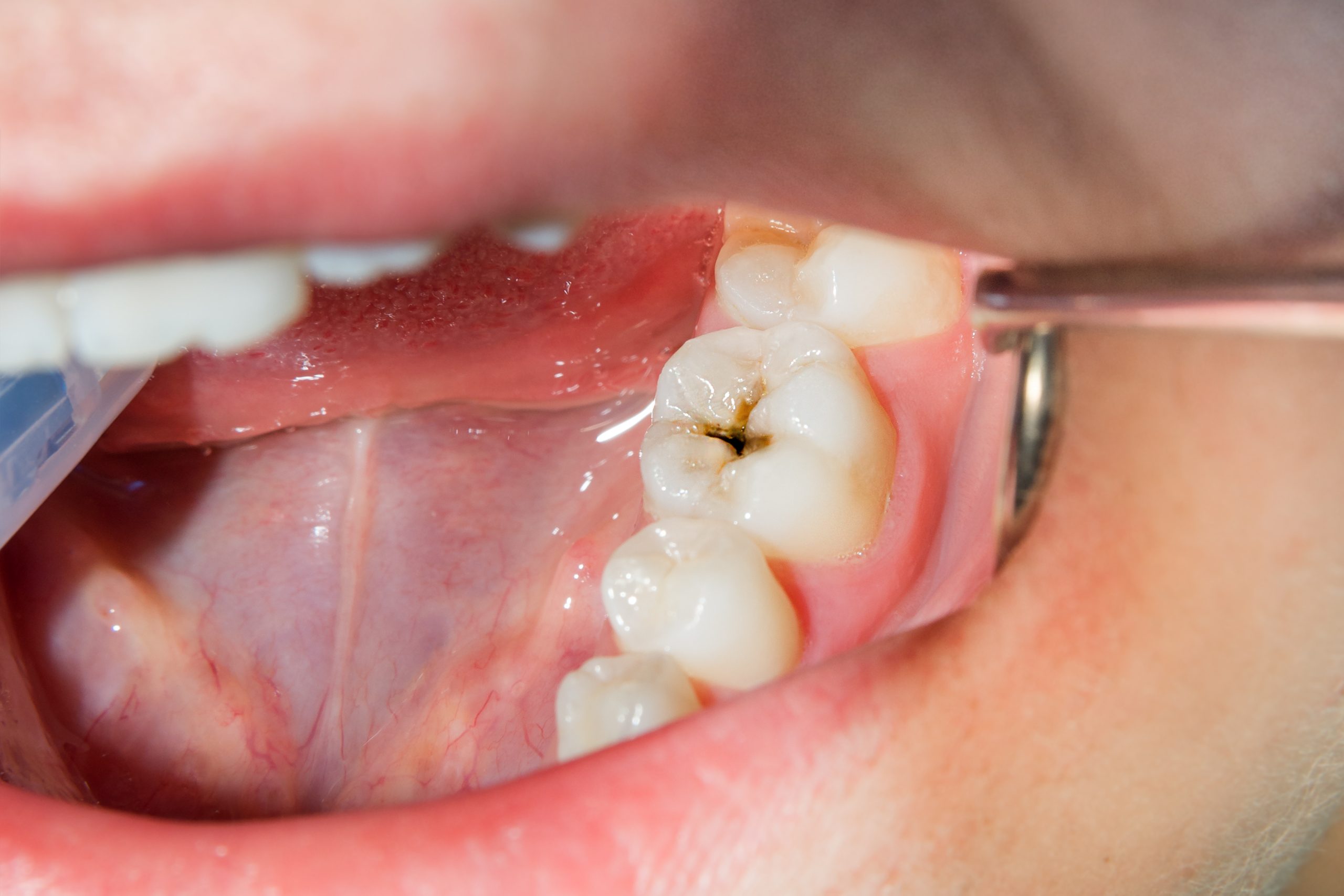 Conservativa odontoiatrica, cura della carie con composito a Perugia