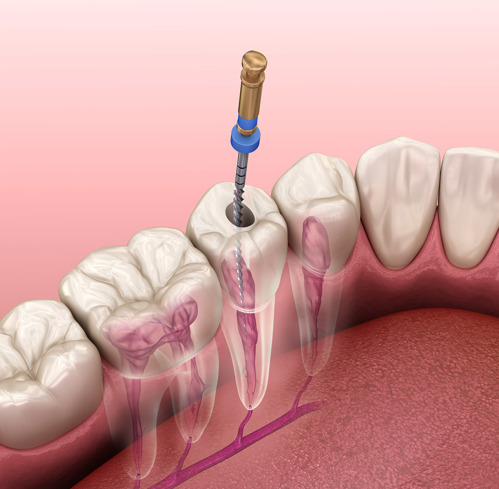 Endodonzia, terapia canalare per salvare il dente, Perugia