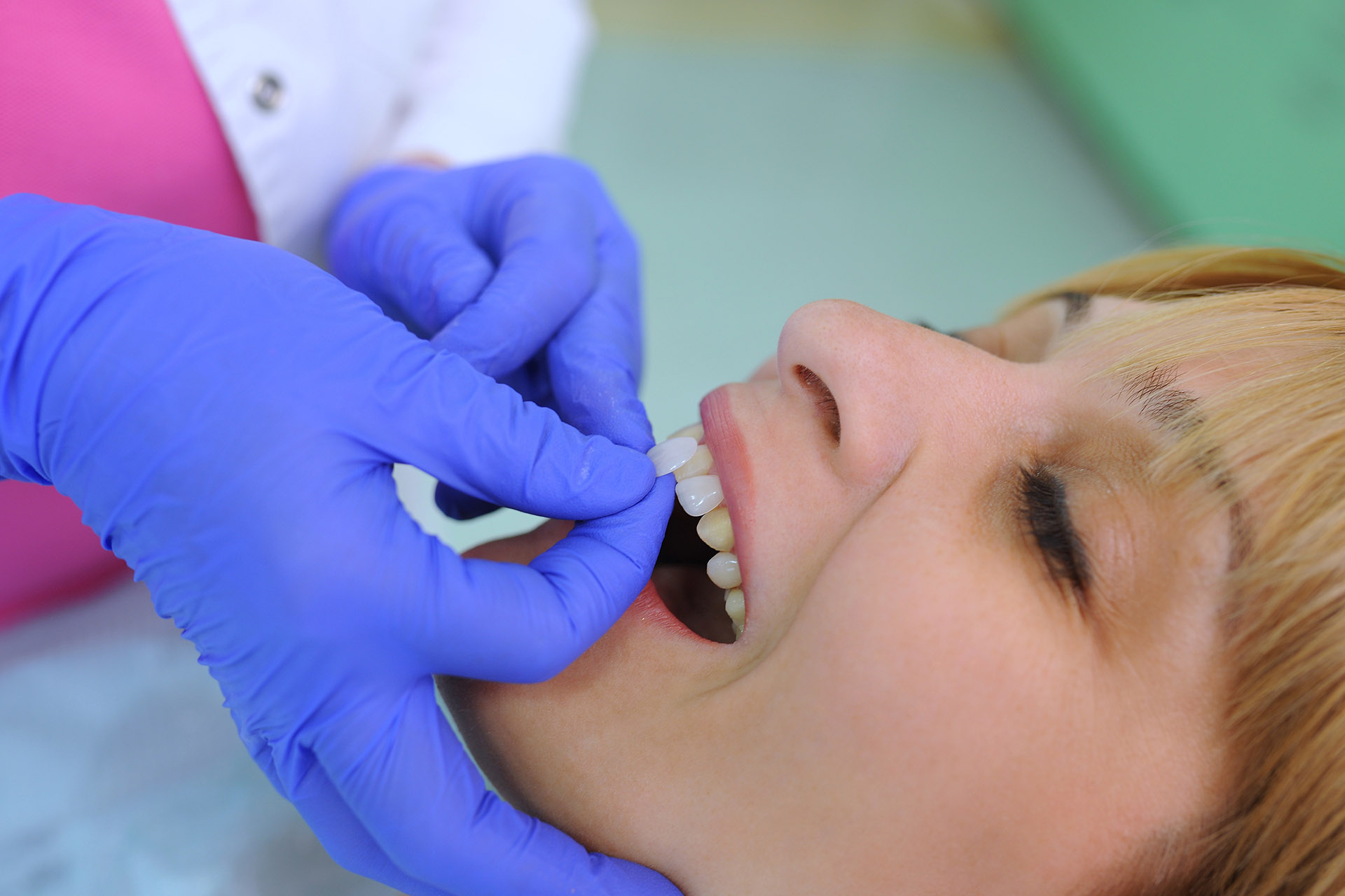 Sbiancamento dentale professionale con luce LED, Perugia