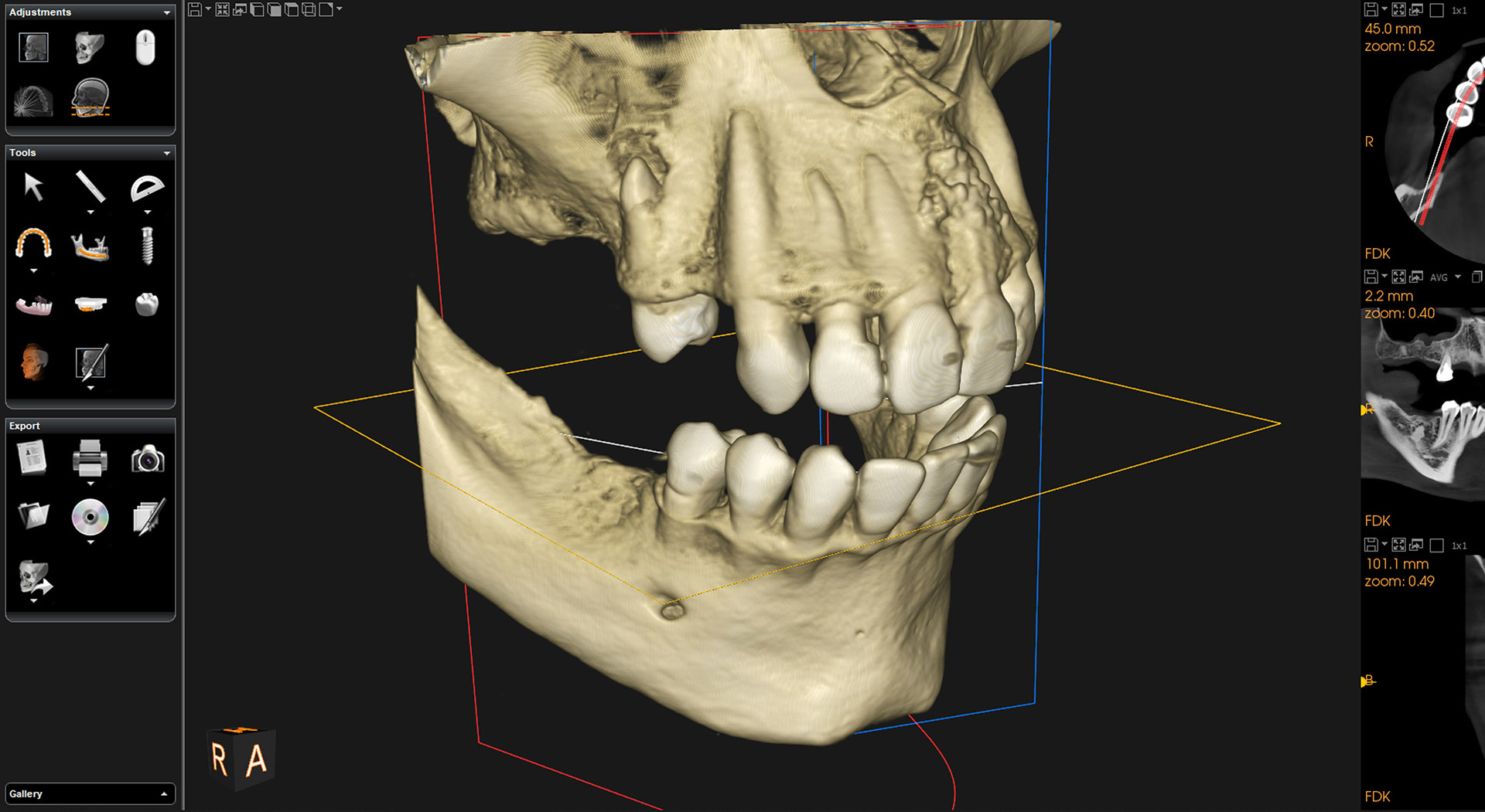 Pianificazione 3D con CBCT e software guidato, Perugia