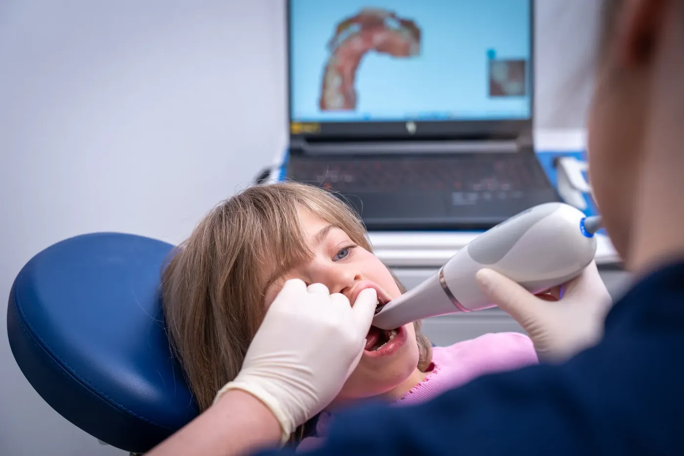 Ortodonzia pediatrica con scanner intraorale digitale, Perugia