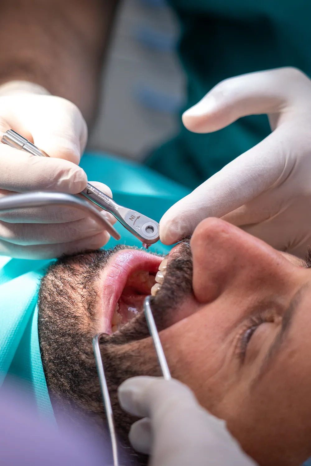 Serraggio dei componenti implantari nel carico immediato, Perugia